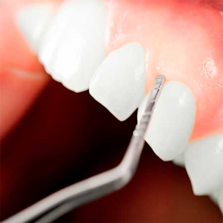 cirurgia-plastica-gengival-bianchine