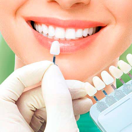 clareamento_dental