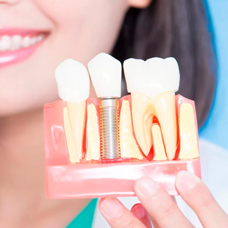 tipos_de_implantes_dentarios_doutor_bianchine