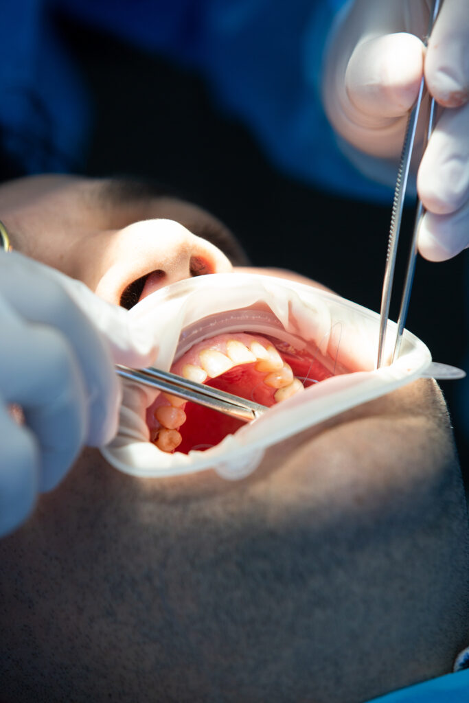 Cirurgia Siso Incluso