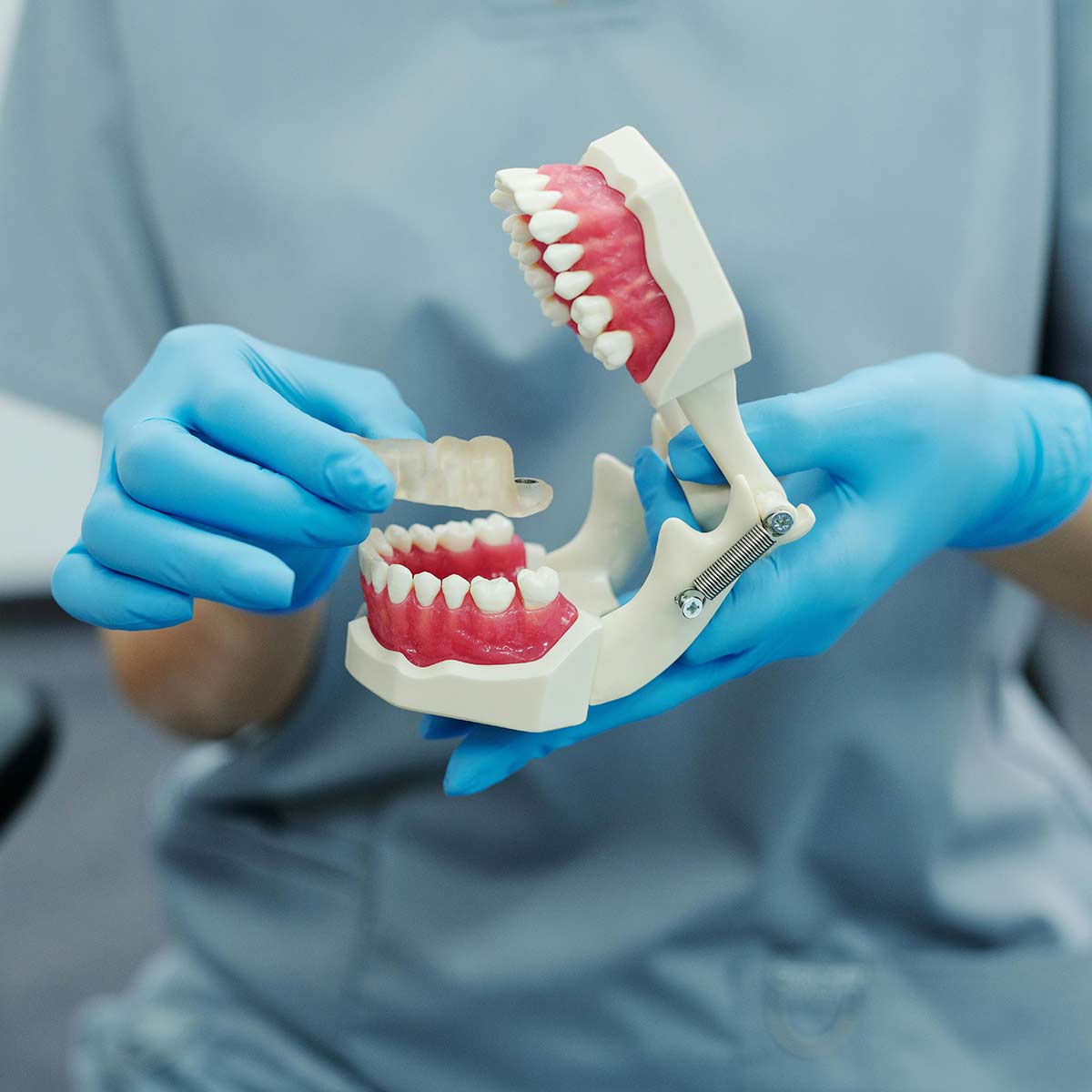 Prótese-Unitária-Sobre-Implante-_-bianchine_odontologia